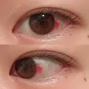 二重埋没 / 上まぶたの脂肪取り 湘南美容クリニック 水戸院 DAY 31 サムネイル用