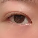 二重埋没 / 上まぶたの脂肪取り 湘南美容クリニック 水戸院 DAY 31 サムネイル用