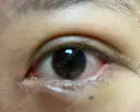 二重埋没 / 目頭切開 / 目尻切開 / タレ目形成・グラマラスライン（切開） HAAB×DREAM BEAUTY CLINIC 東京本院 DAY 6 サムネイル用