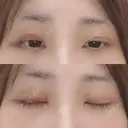 二重埋没 / 下まぶたの脂肪取り 湘南美容クリニック 宇都宮院 DAY 2 サムネイル用