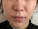 糸リフト ノーチェビューティクリニック DAY 13 サムネイル用