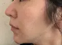 糸リフト ノーチェビューティクリニック DAY 13 サムネイル用