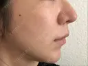 糸リフト ノーチェビューティクリニック DAY 13 サムネイル用