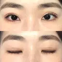 二重切開 / 上まぶたの脂肪取り 松下皮フ形成外科 DAY 16 サムネイル用