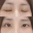 二重埋没 / 下まぶたの脂肪取り 湘南美容クリニック 宇都宮院 DAY 3 サムネイル用