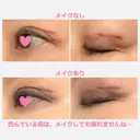 二重切開 / 上まぶたたるみ取り 表参道スキンクリニック 表参道院 DAY 181 サムネイル用