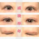 二重切開 / 上まぶたたるみ取り 表参道スキンクリニック 表参道院 AFTER サムネイル用