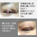 二重切開 / 上まぶたたるみ取り 表参道スキンクリニック 表参道院 DAY 181 サムネイル用