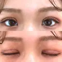 二重切開 EMMA CLINIC（エマクリニック） DAY 14 サムネイル用