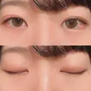 二重埋没 / 上まぶたの脂肪取り 湘南美容クリニック 水戸院 DAY 34 サムネイル用