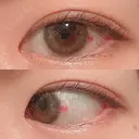 二重埋没 / 上まぶたの脂肪取り 湘南美容クリニック 水戸院 DAY 34 サムネイル用