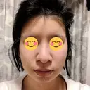 隆鼻術 / 鼻尖形成（切開） / 鼻中隔延長（切開） / 骨切幅寄せ 表参道スキンクリニック 表参道院 DAY 27 サムネイル用