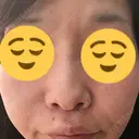 小鼻縮小（切開） / その他（鼻） 湘南メディカル記念病院（両国） AFTER サムネイル用