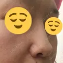 小鼻縮小（切開） / その他（鼻） 湘南メディカル記念病院（両国） DAY 71 サムネイル用