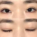 二重切開 / 上まぶたの脂肪取り 松下皮フ形成外科 DAY 20 サムネイル用