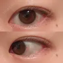 二重埋没 / 上まぶたの脂肪取り 湘南美容クリニック 水戸院 DAY 36 サムネイル用