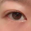 二重埋没 / 上まぶたの脂肪取り 湘南美容クリニック 水戸院 DAY 36 サムネイル用