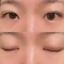 二重埋没 / 上まぶたの脂肪取り 湘南美容クリニック 水戸院 AFTER サムネイル用