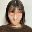 糸リフト / バッカルファット除去 / 脂肪吸引（顔） / ボトックス（エラ・小顔） WOM CLINIC GINZA （ワム クリニック ギンザ） DAY 83 サムネイル用