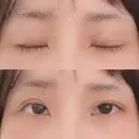 二重埋没 / 下まぶたの脂肪取り 湘南美容クリニック 宇都宮院 AFTER サムネイル用