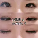 目頭切開 / 眼瞼下垂（切開） 白山クリニック 大分 DAY 14 サムネイル用