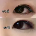 目頭切開 / 眼瞼下垂（切開） 白山クリニック 大分 DAY 14 サムネイル用