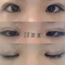 目頭切開 / 眼瞼下垂（切開） 白山クリニック 大分 DAY 15 サムネイル用