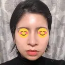 隆鼻術 / 鼻尖形成（切開） / 鼻中隔延長（切開） / 骨切幅寄せ 表参道スキンクリニック 表参道院 DAY 30 サムネイル用