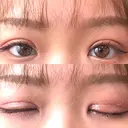 二重切開 EMMA CLINIC（エマクリニック） DAY 19 サムネイル用