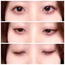 二重埋没 / 眼瞼下垂（切開） / クマ治療 / 下まぶたの脂肪取り THE MEDICAL SALON DAY 472 サムネイル用