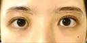 眉下切開 Taide Suenaga Clinic（タイデスエナガクリニック） DAY 19 サムネイル用