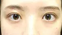 眉下切開 Taide Suenaga Clinic（タイデスエナガクリニック） DAY 22 サムネイル用