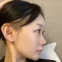 ヒアルロン酸注入（頬） 赤坂プレミアクリニック AFTER サムネイル用