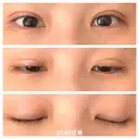 二重埋没 湘南美容クリニック 藤沢院 DAY 4 サムネイル用