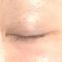 二重切開 / 眼瞼下垂（切開） / 上まぶたの脂肪取り / タレ目形成・グラマラスライン（切開） / 目尻靭帯移動 エイペックス美容外科 DAY 197 サムネイル用