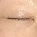 二重切開 / 眼瞼下垂（切開） / 上まぶたの脂肪取り / タレ目形成・グラマラスライン（切開） / 目尻靭帯移動 エイペックス美容外科 DAY 197 サムネイル用