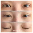 二重埋没 湘南美容クリニック 藤沢院 DAY 5 サムネイル用