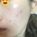 美肌レーザー / シミ取りレーザー たかはし形成外科･美容外科  DAY 4 サムネイル用