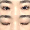 二重切開 / 上まぶたの脂肪取り 松下皮フ形成外科 DAY 27 サムネイル用
