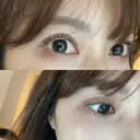 二重切開 ルネッサンス美容外科医院 神戸院 DAY 730 サムネイル用