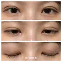 二重埋没 湘南美容クリニック 藤沢院 DAY 6 サムネイル用