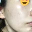 美肌レーザー / シミ取りレーザー たかはし形成外科･美容外科  DAY 5 サムネイル用