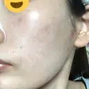 美肌レーザー / シミ取りレーザー たかはし形成外科･美容外科  DAY 5 サムネイル用