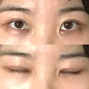 二重切開 / 眼瞼下垂（切開） ブリスクリニック形成外科・美容外科・美容皮膚科 福岡 DAY 8 サムネイル用