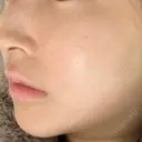 シミ取りレーザー / ピコレーザートーニング（美白・肝斑） UB CLINIC銀座 AFTER サムネイル用