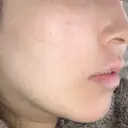 シミ取りレーザー / ピコレーザートーニング（美白・肝斑） UB CLINIC銀座 DAY 46 サムネイル用
