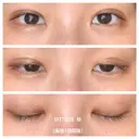 二重埋没 湘南美容クリニック 藤沢院 DAY 7 サムネイル用