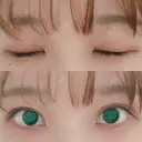 二重埋没 湘南美容クリニック 金沢院 DAY 55 サムネイル用