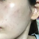 美肌レーザー / シミ取りレーザー たかはし形成外科･美容外科  DAY 7 サムネイル用