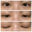 二重埋没 湘南美容クリニック 藤沢院 DAY 8 サムネイル用